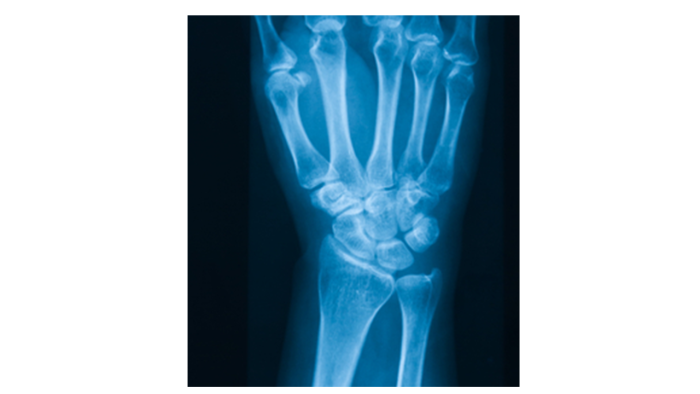 x-ray of hand